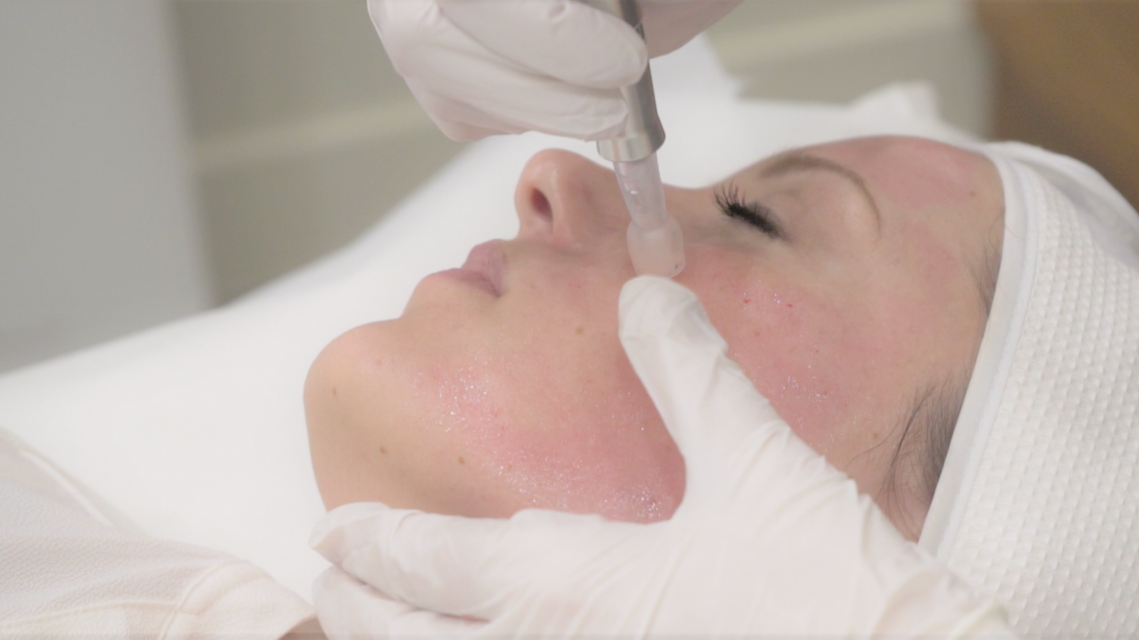 Skin needling, direct needle therapy